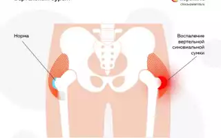 Бурсит тазобедренного сустава