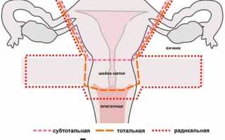 Как осуществляется экстирпация матки (тотальная гистерэктомия)?