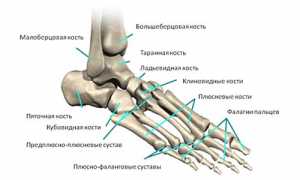 Перелом плюсневой кости стопы