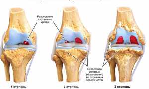 Остеоартроз коленного сустава