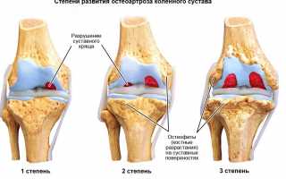 Остеоартроз коленного сустава