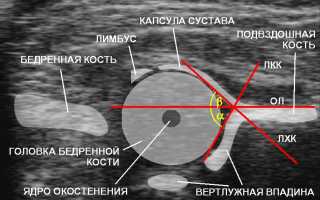 УЗИ тазобедренных суставов