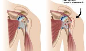 Периартрит плечевого сустава