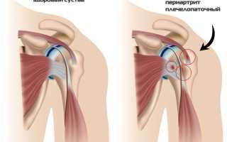 Периартрит плечевого сустава