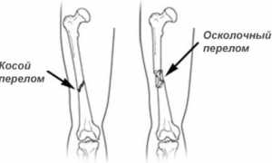 Оскольчатый перелом