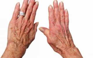 Боль при сгибании пальцев рук