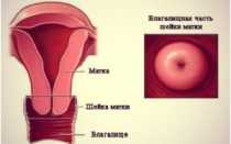 Длина шейки матки при беременности: понятие укороченной и удлиненной шейки