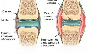 Как лечить синовит коленного сустава?