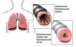 Причины развития бронхиальной астмы