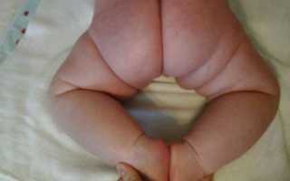 Незрелость тазобедренных суставов у новорожденного