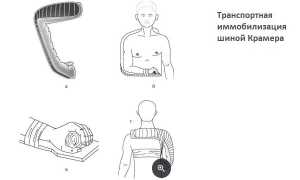 Транспортная иммобилизация при переломах