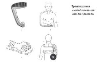 Транспортная иммобилизация при переломах