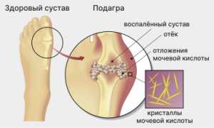 Разрушение суставов подагрой