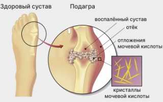 Разрушение суставов подагрой