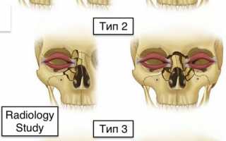 Перелом лицевой кости
