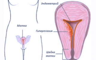 Гиперплазия эндометрия в пременопаузе: симптомы проявления и способы лечения