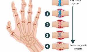 Ревматоидный артрит пальцев рук