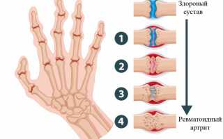 Ревматоидный артрит пальцев рук
