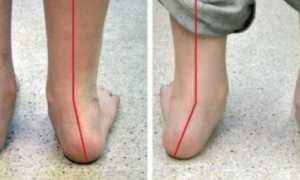 Ортопедическая обувь при вальгусной деформации