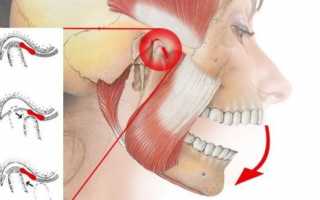 Артроз челюстного сустава