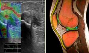 УЗИ коленного сустава