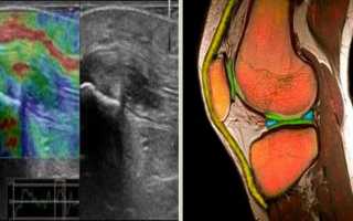 УЗИ коленного сустава